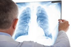 Mukoviszidose Symptome Mukoviszidose Diagnose